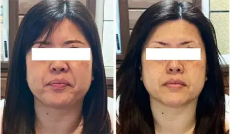 REY BITEN GOLD CREAM Professional anti-wrinkle and sagging cream, 30 g