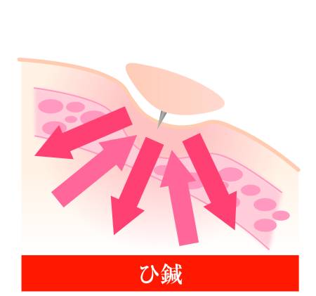 Shinshu Hi Acupuncture needles, 30 pieces