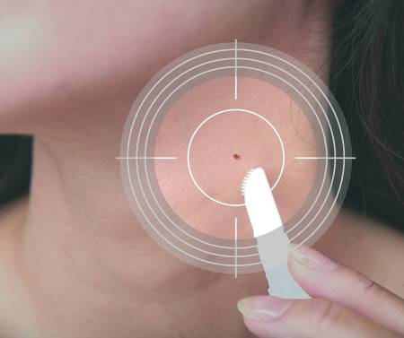 TSUBUPORON PEELING GEL a Remedy against warts