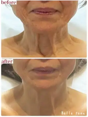 REY BITEN GOLD CREAM Professional anti-wrinkle and sagging cream, 30 g