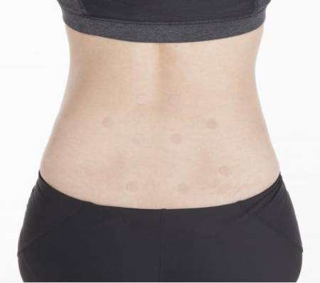 Shinshu Hi Acupuncture needles, 30 pieces