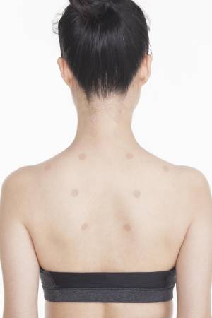 Shinshu Hi Acupuncture needles, 30 pieces