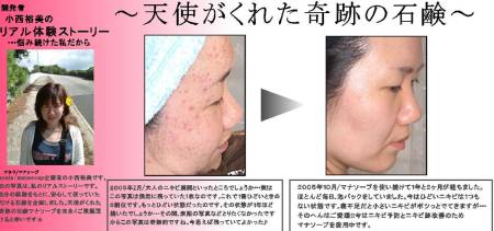 Anela Mana Soap Peeling soap with glycolic acid 7% against acne with foam mesh as a gift!